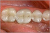photo of teeth with composite white fillings