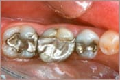 photo of teeth with old metal fillings