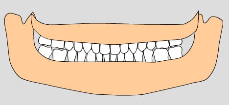 illustration of permanent teeth, 12-13 years