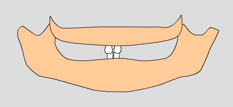 illustration of baby teeth, 8-10 months