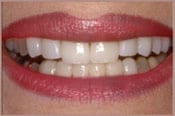 photo of teeth after veneers