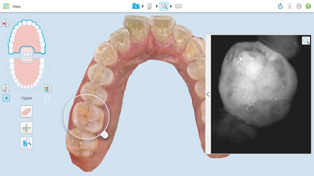An snapshot of the computer screen showing the teeth and gum tissue the itero scanner digitally captures with its radiation free laser